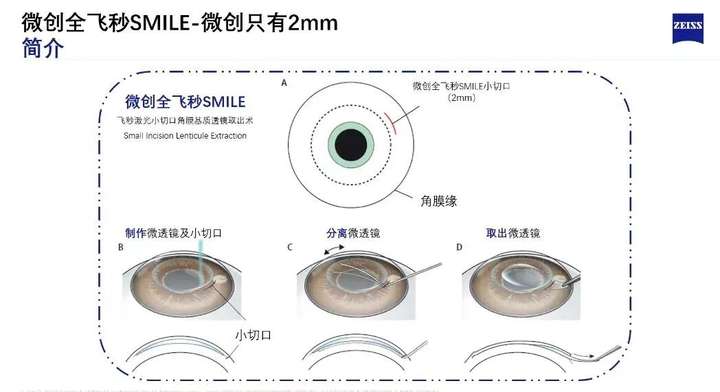 全新升级！微创全飞秒精准40-VISULYZE正式落户合肥瑶海普瑞眼科医院(图4)